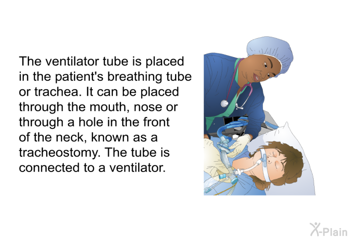 The ventilator tube is placed in the patient's breathing tube or trachea. It can be placed through the mouth, nose or through a hole in the front of the neck, known as a tracheostomy. The tube is connected to a ventilator.