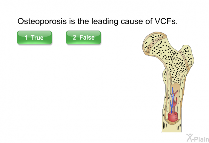 Osteoporosis is the leading cause of VCFs. Press True or False