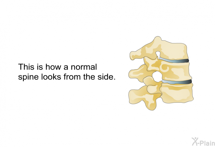 This is how a normal spine looks from the side.