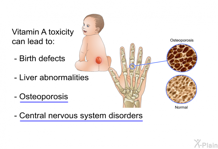 Vitamin A toxicity can lead to:  Birth defects Liver abnormalities Osteoporosis Central nervous system disorders