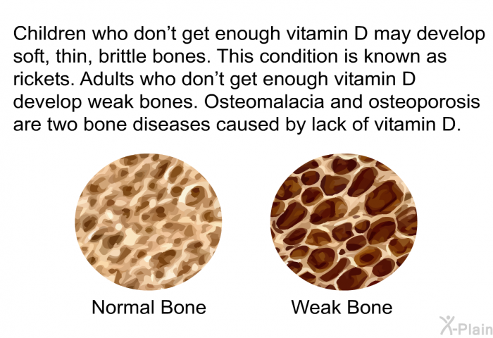 Children who don't get enough vitamin D may develop soft, thin, brittle bones. This condition is known as rickets. Adults who don't get enough vitamin D develop weak bones. Osteomalacia and osteoporosis are two bone diseases caused by lack of vitamin D.