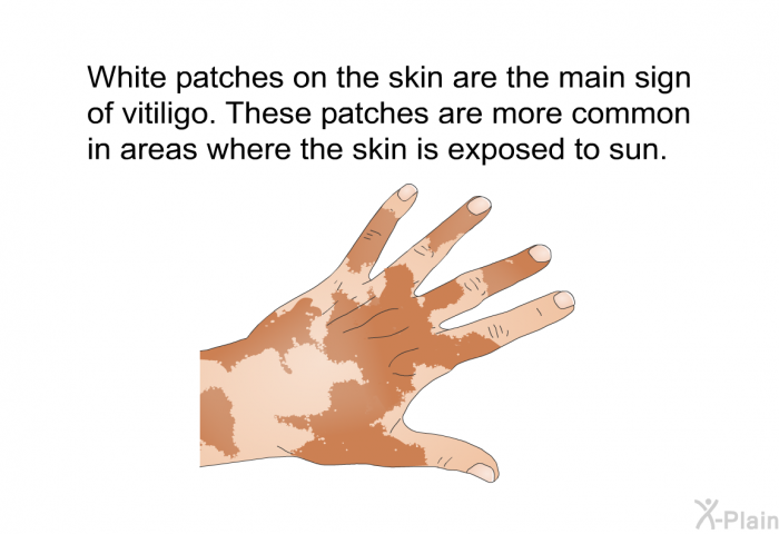 White patches on the skin are the main sign of vitiligo. These patches are more common in areas where the skin is exposed to sun.