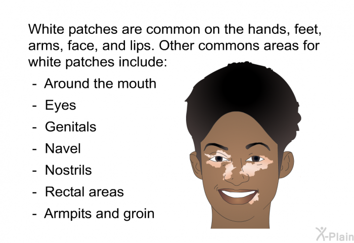 White patches are common on the hands, feet, arms, face, and lips. Other commons areas for white patches include:  Around the mouth Eyes Genitals Navel Nostrils Rectal areas Armpits and groin