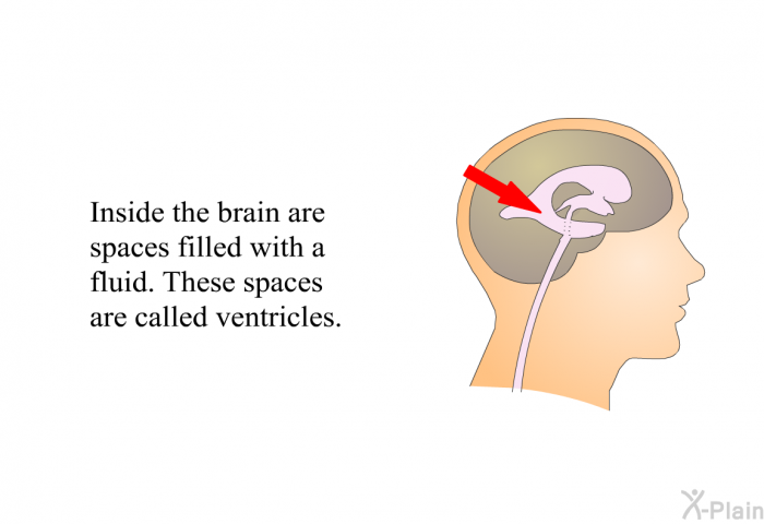 Inside the brain are spaces filled with a fluid. These spaces are called “ventricles”.