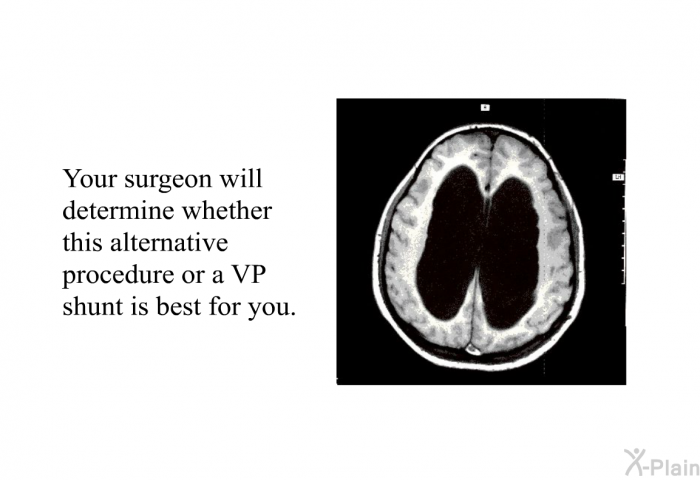 Your surgeon will determine whether this alternative procedure or a VP shunt is best for you.