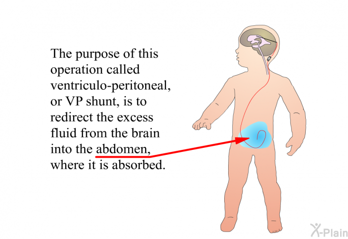 The purpose of this operation called ventriculo-peritoneal, or VP shunt, is to redirect the excess fluid from the brain into the abdomen, where it is absorbed.