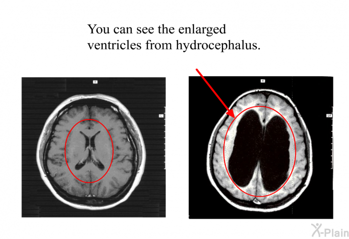 You can see the enlarged ventricles from hydrocephalus.