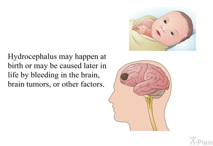 Hydrocephalus may happen at birth or may be caused later in life by bleeding in the brain, brain tumors, or other factors.