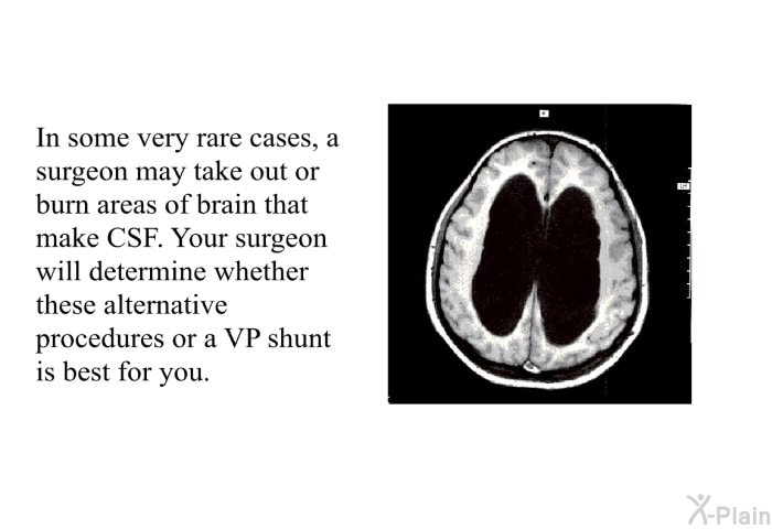 In some very rare cases, a surgeon may take out or burn areas of brain that make CSF. Your surgeon will determine whether these alternative procedures or a VP shunt is best for you.