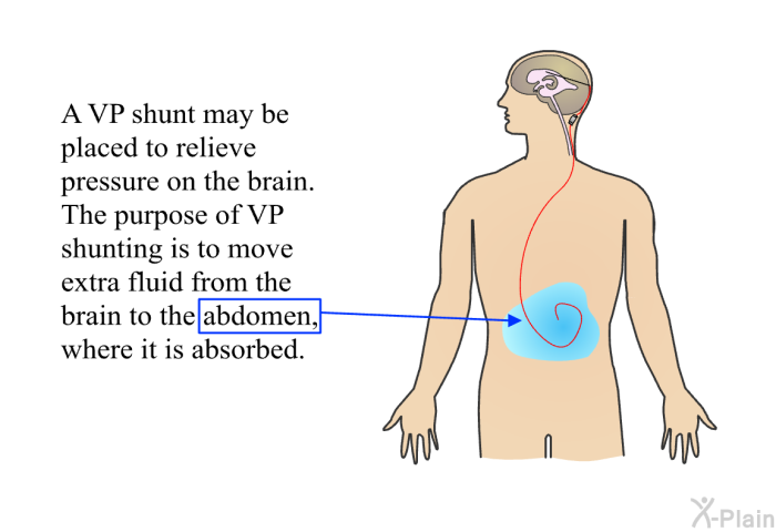 A VP shunt may be placed to relieve pressure on the brain. The purpose of VP shunting is to move extra fluid from the brain to the abdomen, where it is absorbed.