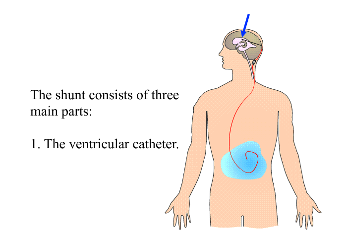 The shunt consists of three main parts:  The ventricular catheter.