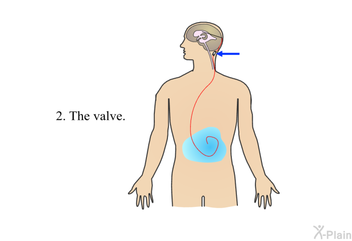 The valve.