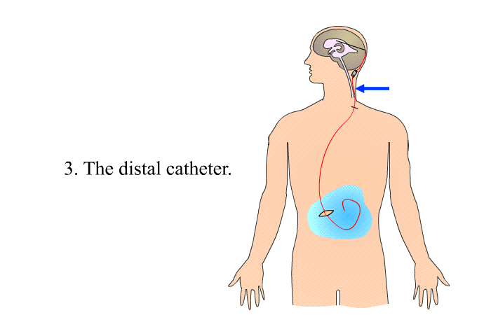 The distal catheter.