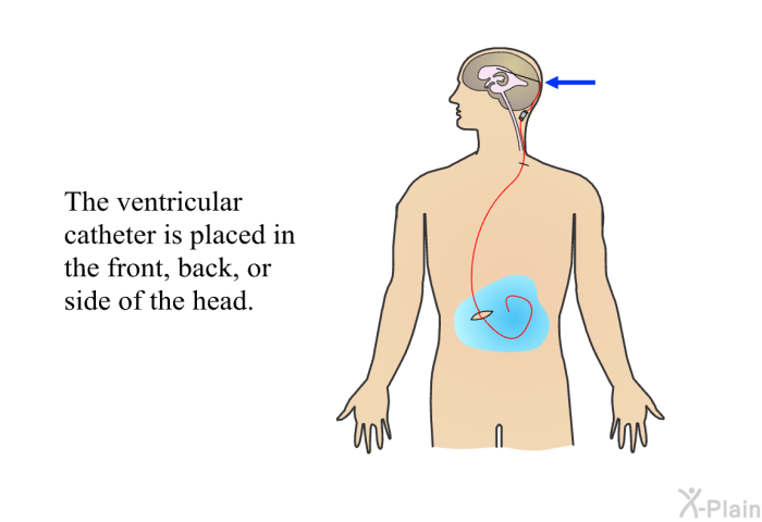 The ventricular catheter is placed in the front, back, or side of the head.