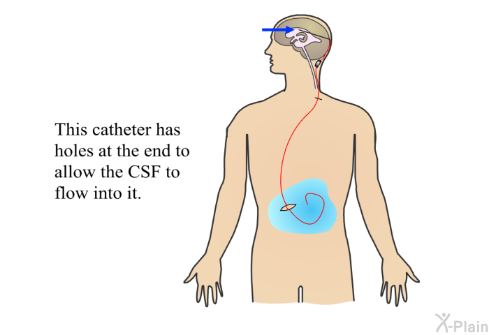 This catheter has holes at the end to allow the CSF to flow into it.