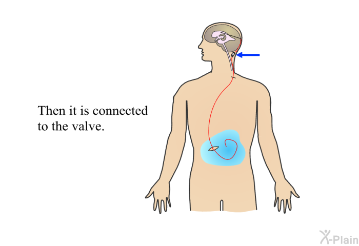 Then it is connected to the valve.