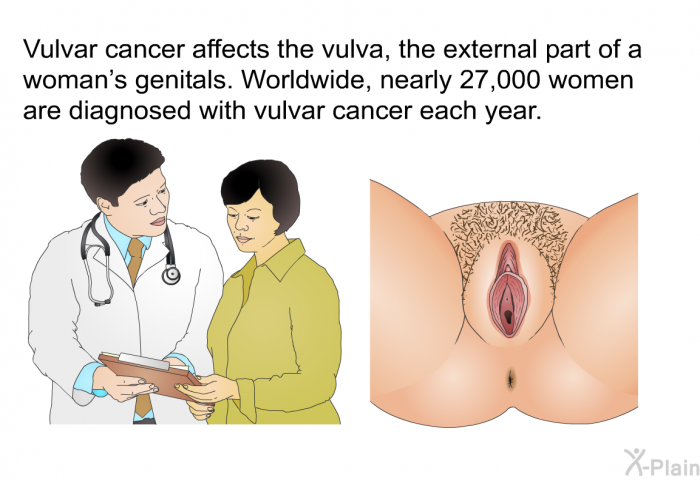 Vulvar cancer affects the vulva, the external part of a woman's genitals. Worldwide, nearly 27,000 women are diagnosed with vulvar cancer each year.