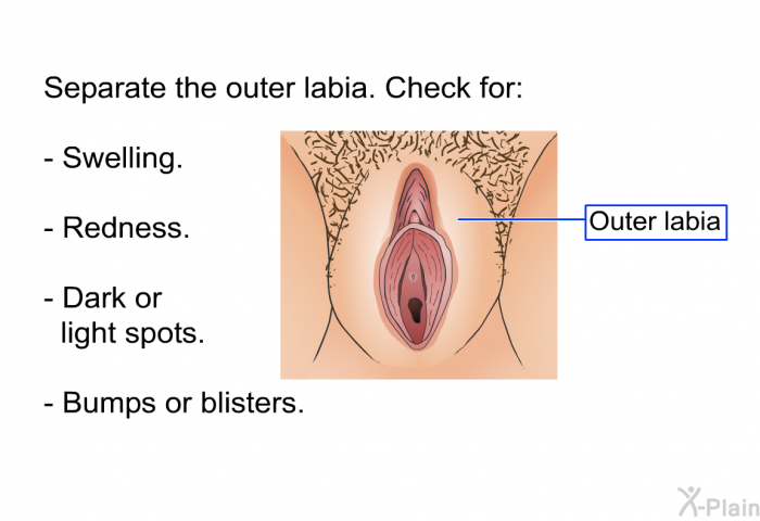 Separate the outer labia. Check for:  Swelling. Redness. Dark or light spots. Bumps or blisters.