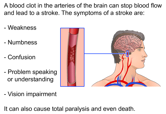 A blood clot in the arteries of the brain can stop blood flow and lead to a stroke. The symptoms of a stroke are:  Weakness Numbness Confusion Problem speaking or understanding Vision impairment  
 It can also cause total paralysis and even death.
