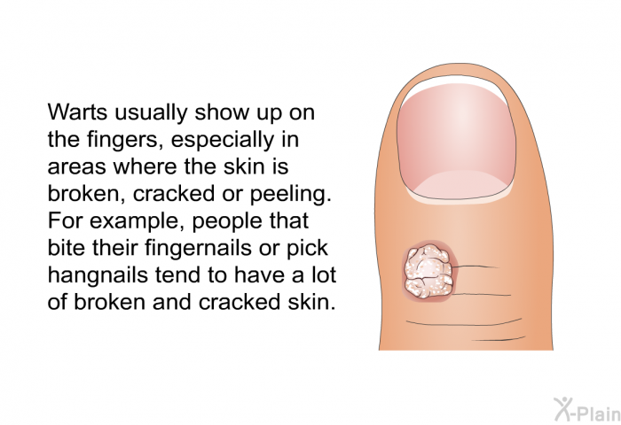 Warts usually show up on the fingers, especially in areas where the skin is broken, cracked or peeling. For example, people that bite their fingernails or pick hangnails tend to have a lot of broken and cracked skin.