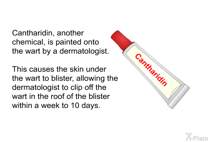 Cantharidin, another chemical, is painted onto the wart by a dermatologist. This causes the skin under the wart to blister, allowing the dermatologist to clip off the wart in the roof of the blister within a week to 10 days.