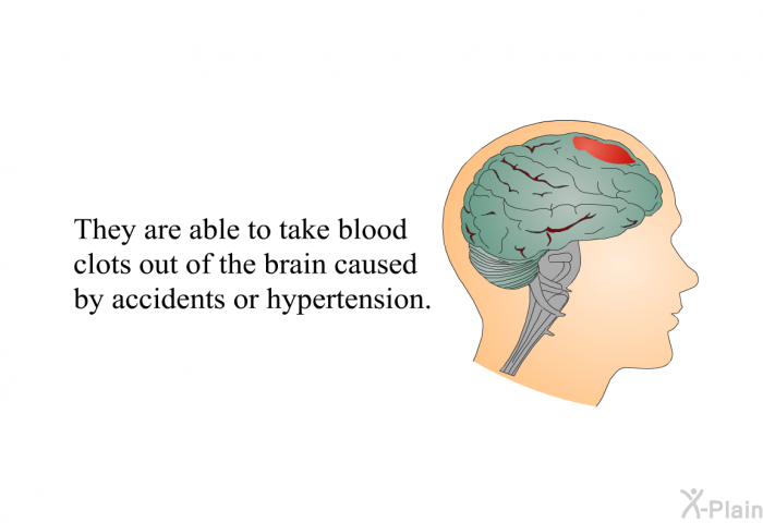 They are able to take blood clots out of the brain caused by accidents or hypertension.