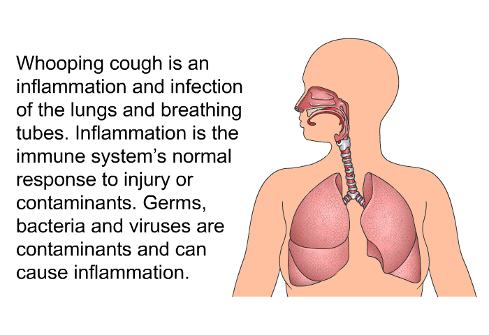 Whooping cough is an inflammation and infection of the lungs and breathing tubes. Inflammation is the immune system's normal response to injury or contaminants. Germs, bacteria and viruses are contaminants and can cause inflammation.
