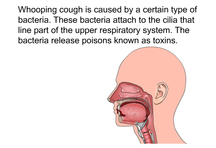 Whooping cough is caused by a certain type of bacteria. These bacteria attach to the cilia that line part of the upper respiratory system. The bacteria release poisons known as toxins.