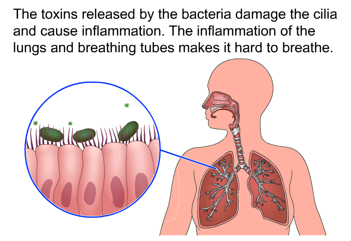 The toxins released by the bacteria damage the cilia and cause inflammation. The inflammation of the lungs and breathing tubes makes it hard to breathe.