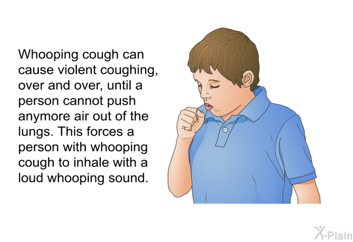 Whooping cough can cause violent coughing, over and over, until a person cannot push anymore air out of the lungs. This forces a person with whooping cough to inhale with a loud whooping sound.