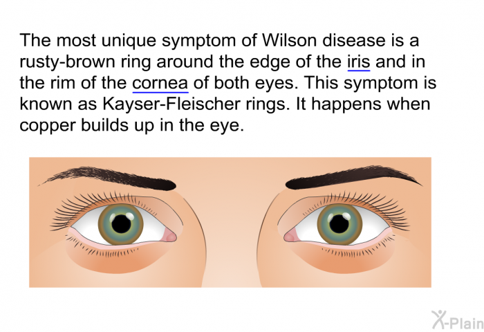 The most unique symptom of Wilson disease is a rusty-brown ring around the edge of the iris and in the rim of the cornea of both eyes. This symptom is known as Kayser-Fleischer rings. It happens when copper builds up in the eye.