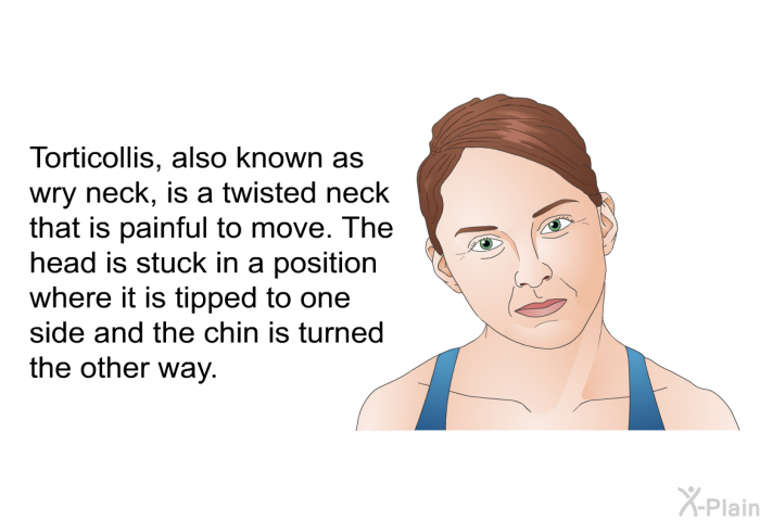 Torticollis, also known as wry neck, is a twisted neck that is painful to move. The head is stuck in a position where it is tipped to one side and the chin is turned the other way.