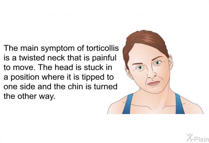 The main symptom of torticollis is a twisted neck that is painful to move. The head is stuck in a position where it is tipped to one side and the chin is turned the other way.