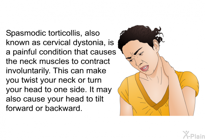 Spasmodic torticollis, also known as cervical dystonia, is a painful condition that causes the neck muscles to contract involuntarily. This can make you twist your neck or turn your head to one side. It may also cause your head to tilt forward or backward.