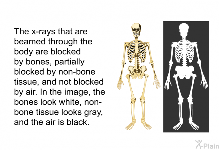 The x-rays that are beamed through the body are blocked by bones, partially blocked by non-bone tissue, and not blocked by air. In the image, the bones look white, non-bone tissue looks gray, and the air is black.