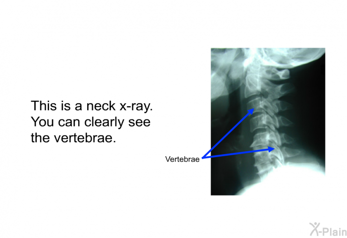 This is a neck x-ray. You can clearly see the vertebrae.