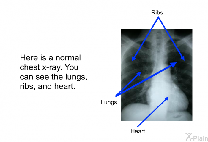 Here is a normal chest x-ray. You can see the lungs, ribs, and heart.