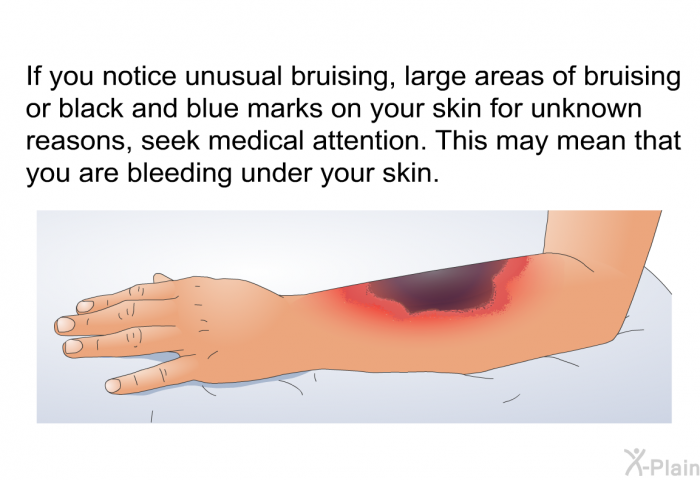 If you notice unusual bruising, large areas of bruising or black and blue marks on your skin for unknown reasons, seek medical attention. This may mean that you are bleeding under your skin.