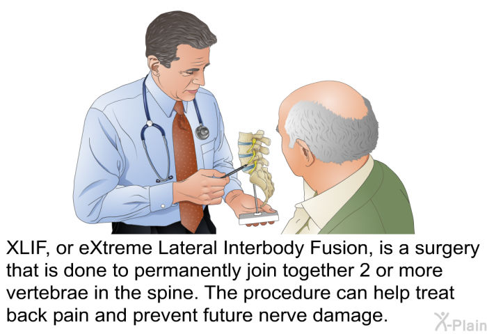 XLIF, or eXtreme Lateral Interbody Fusion, is a surgery that is done to permanently join together 2 or more vertebrae in the spine. The procedure can help treat back pain and prevent future nerve damage.