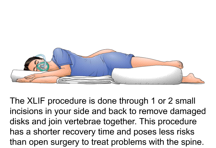 The XLIF procedure is done through 1 or 2 small incisions in your side and back to remove damaged disks and join vertebrae together. This procedure has a shorter recovery time and poses less risks than open surgery to treat problems with the spine.