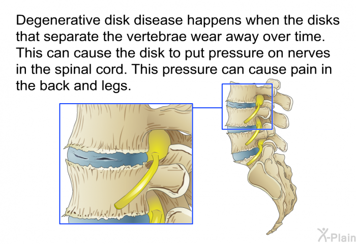 Degenerative disk disease happens when the disks that separate the vertebrae wear away over time. This can cause the disk to put pressure on nerves in the spinal cord. This pressure can cause pain in the back and legs.
