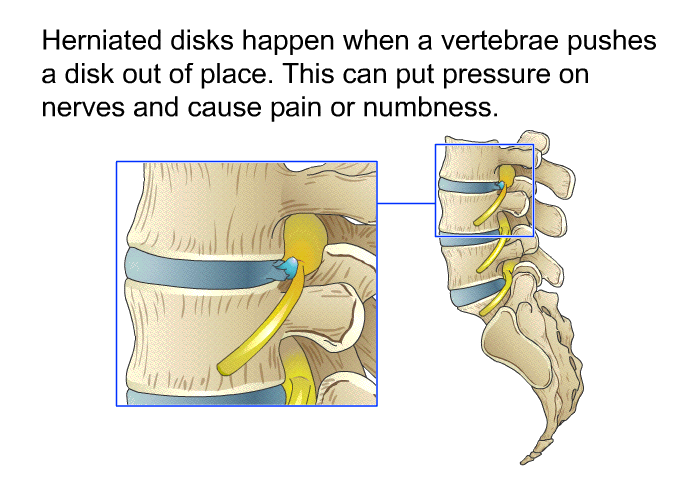 Herniated disks happen when a vertebrae pushes a disk out of place. This can put pressure on nerves and cause pain or numbness.