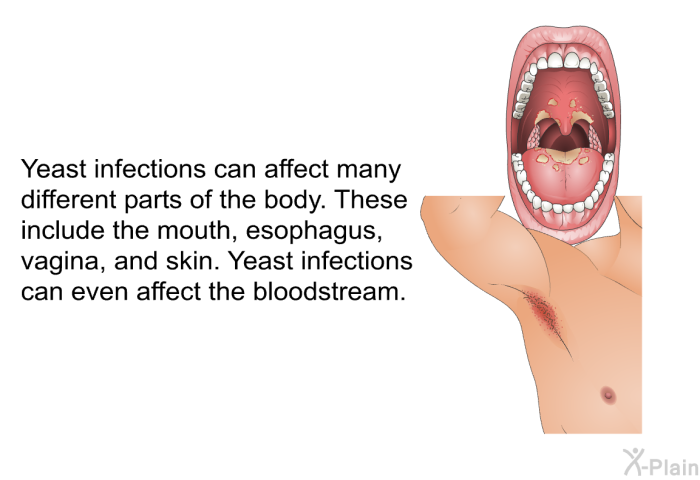 Yeast infections can affect many different parts of the body. These include the mouth, esophagus, vagina, and skin. Yeast infections can even affect the bloodstream.