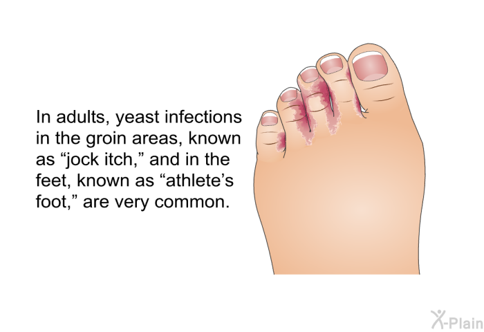 In adults, yeast infections in the groin areas, known as “jock itch,” and in the feet, known as “athlete's foot,” are very common.