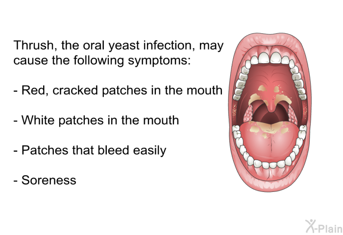 Thrush, the oral yeast infection, may cause the following symptoms:  Red, cracked patches in the mouth White patches in the mouth Patches that bleed easily Soreness