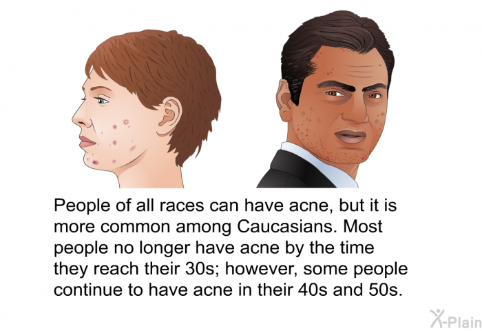People of all races can have acne, but it is more common among Caucasians. Most people no longer have acne by the time they reach their 30s; however, some people continue to have acne in their 40s and 50s.