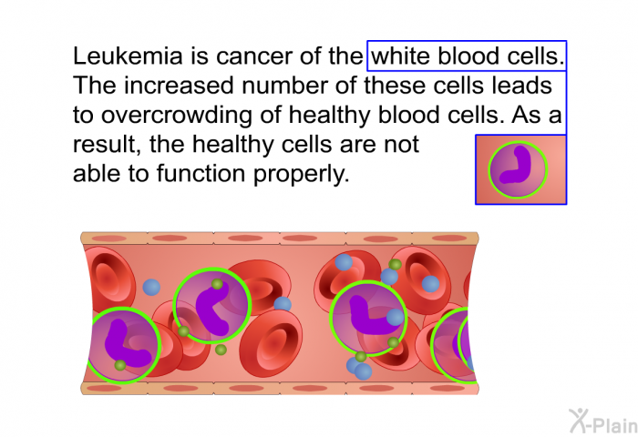 Leukemia is cancer of the white blood cells. The increased number of these cells leads to overcrowding of healthy blood cells. As a result, the healthy cells are not able to function properly.