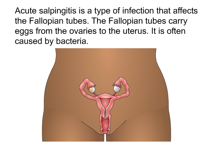 Acute salpingitis is a type of infection that affects the Fallopian tubes. The Fallopian tubes carry eggs from the ovaries to the uterus. It is often caused by bacteria.