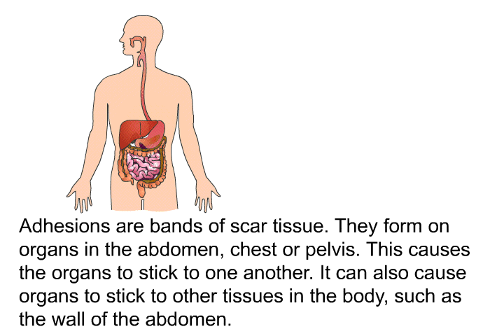 Adhesions are bands of scar tissue. They form on organs in the abdomen, chest or pelvis. This causes the organs to stick to one another. It can also cause organs to stick to other tissues in the body, such as the wall of the abdomen.