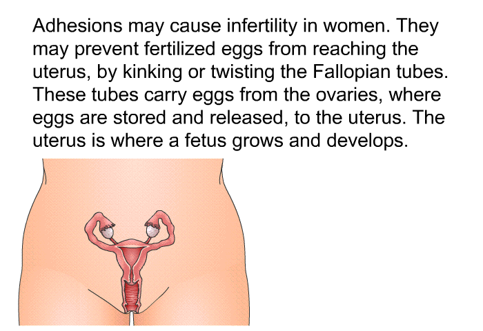 Adhesions may cause infertility in women. They may prevent fertilized eggs from reaching the uterus, by kinking or twisting the Fallopian tubes. These tubes carry eggs from the ovaries, where eggs are stored and released, to the uterus. The uterus is where a fetus grows and develops.